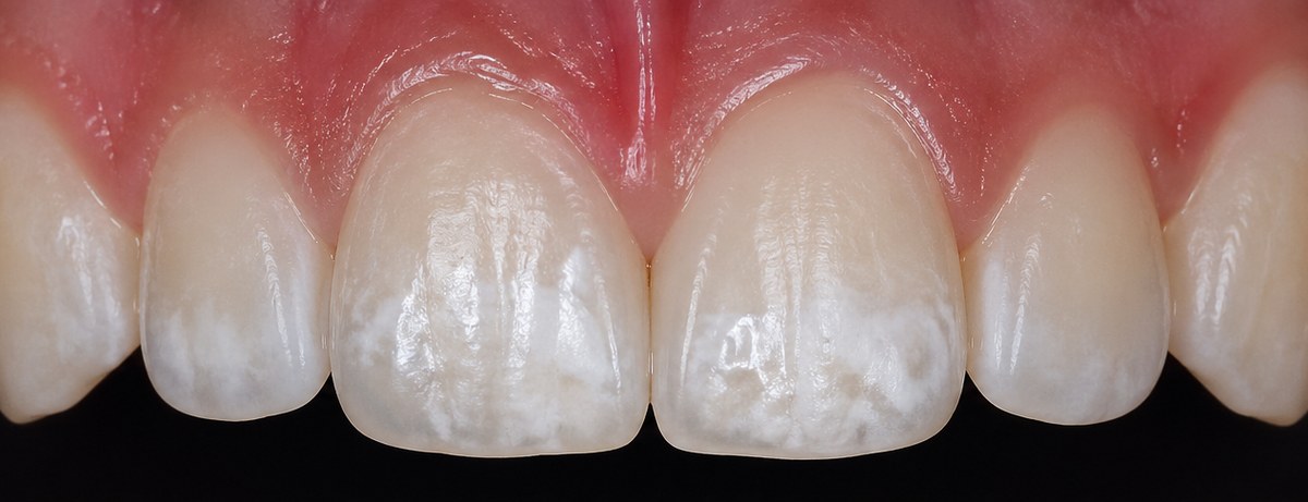 Zähne mit White Spots vor der Behandlung